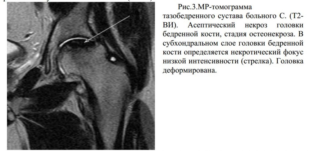 Асептический некроз голеностопного сустава