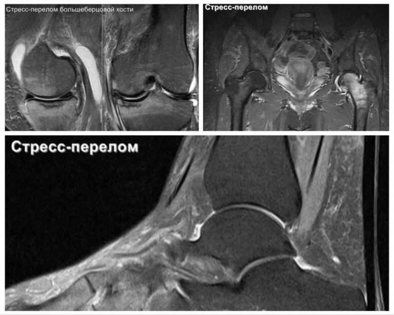 stress fracture aseptic necrosis