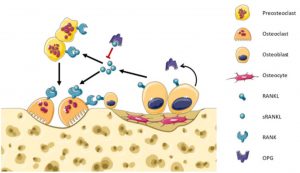 Epstein-Barr virus causes avascular necrosis